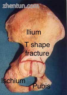 T shape fracture shown on bone model.jpg