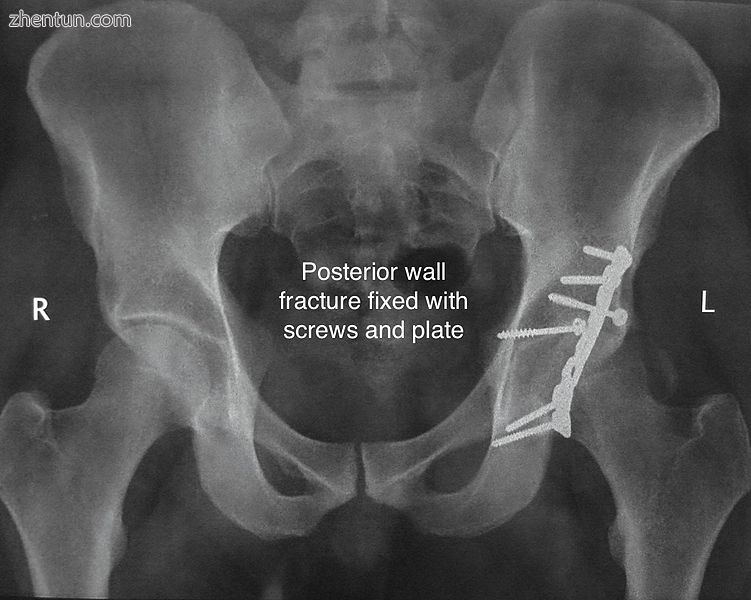 Posterior wall fracture fixed with screws and plate.jpg