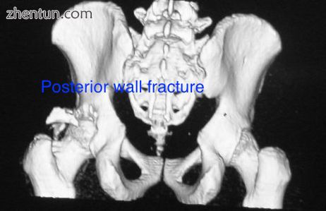 Posterior wall fracture as seen on 3-D CT scan.jpg