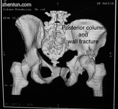 Posterior column and wall fracture as seen on 3D CT.jpg