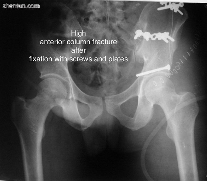 High anterior column fracture after fixation with screws and plates.jpg