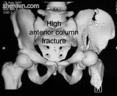 High anterior column fracture 3 D CT scan picture.jpg
