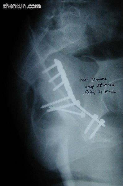 Fixation with screws and plate.jpg