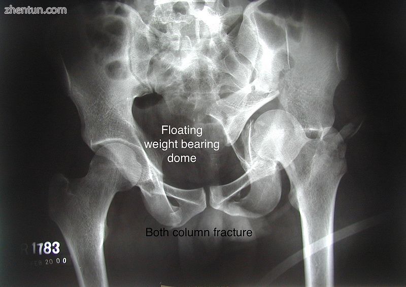 Both column fracture showing floating weight bearing dome.jpg