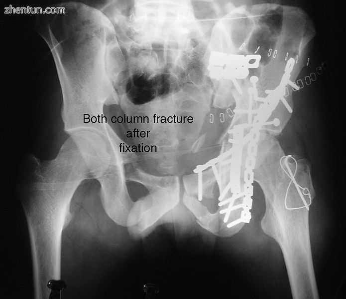 Both column fracture after fixation with screws and plates.jpg