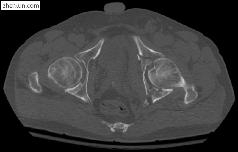 Axial CT image (viewed on bone windows) of a complex comminuted left acetabular .png