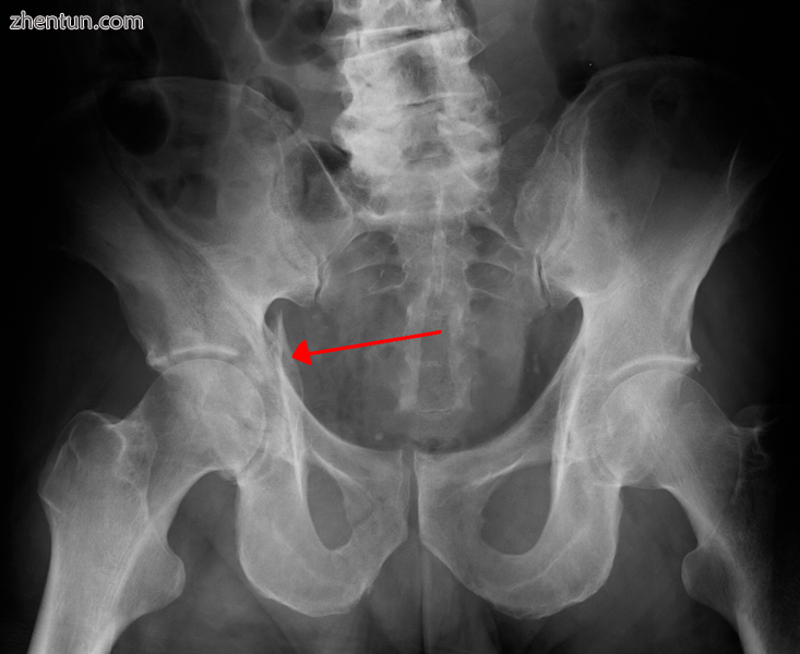 Acetabular fracture as seen on plain X-ray.png