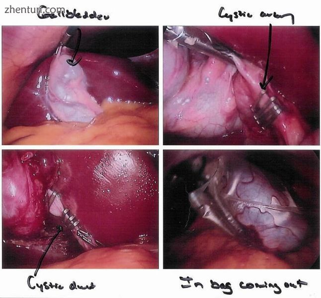 Cholecystectomy as seen through a laparoscope.jpg
