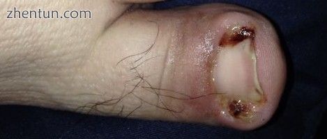 Infection of an ingrown toenail; there is pus (yellow) and resultant inflammatio.jpg