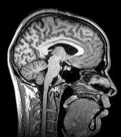 Sagittal MRI slice at the midline..jpg