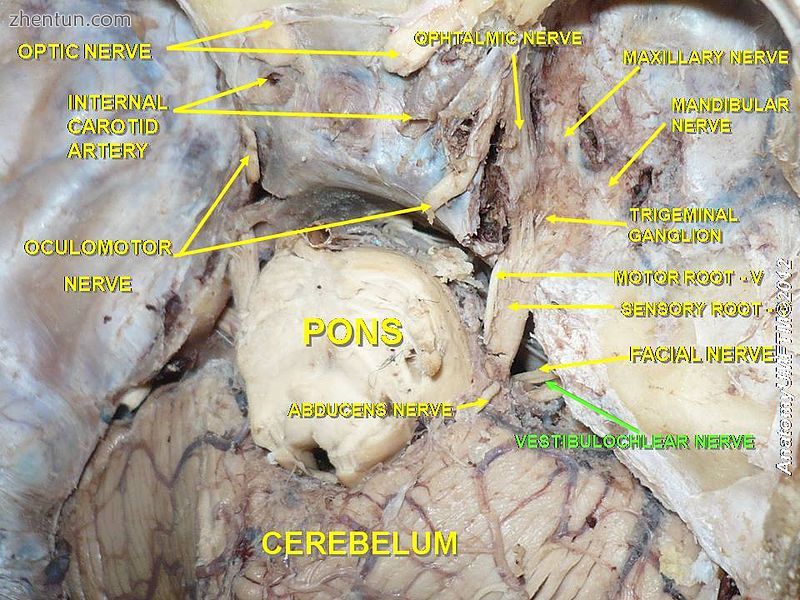 Vestibulocochlear nerve2.JPG