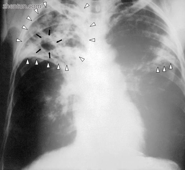Chest X-ray of a person with advanced tuberculosis.jpg
