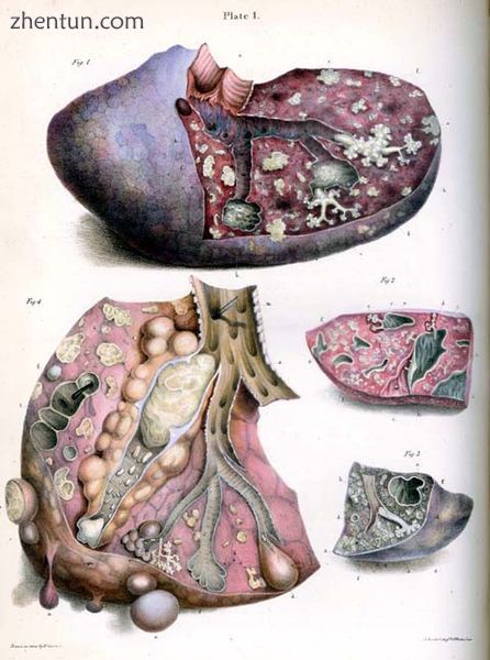 Robert Carswell&#039;s illustration of tubercle[60].jpg