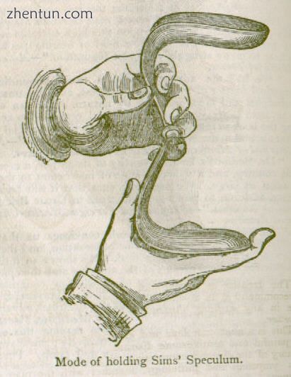 The single-bladed Sims speculum is still in use today..jpg