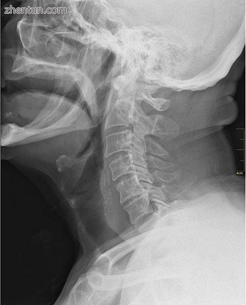 X-ray showing the throat, seen as a dark band to the front of the spine..jpg