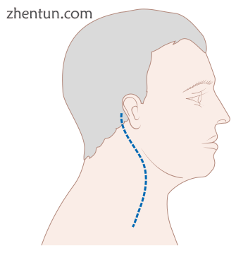 Common scar line after cervical lymph node dissection.png