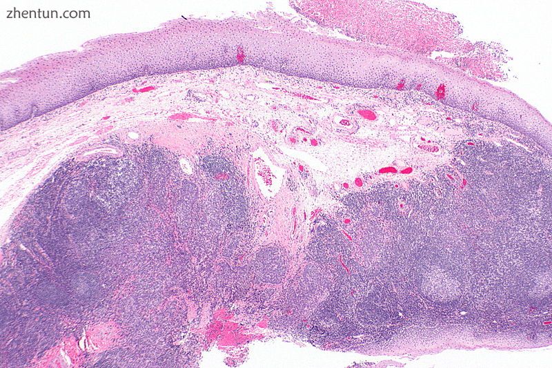 Histopathologic appearance of a poorly differentiated squamous cell carcinoma sp.jpg