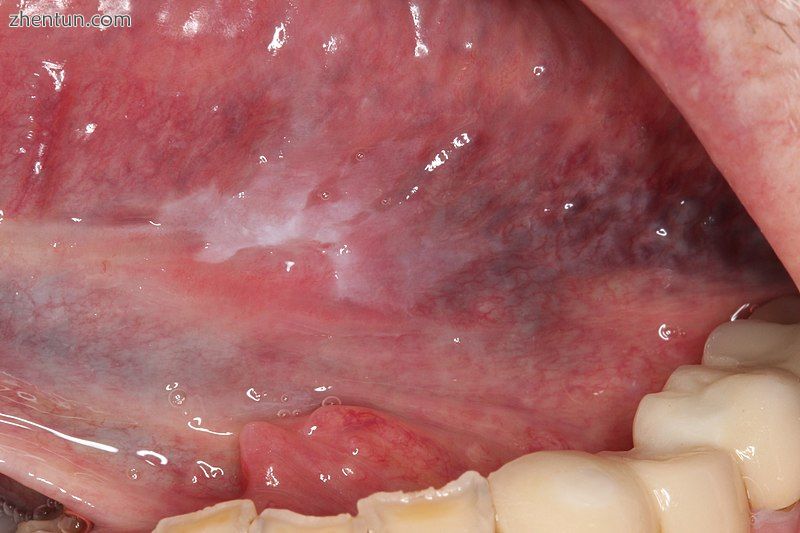 Oral leukoplakia (white patch) on the left tongue. Proven to be severe dysplasia.jpg