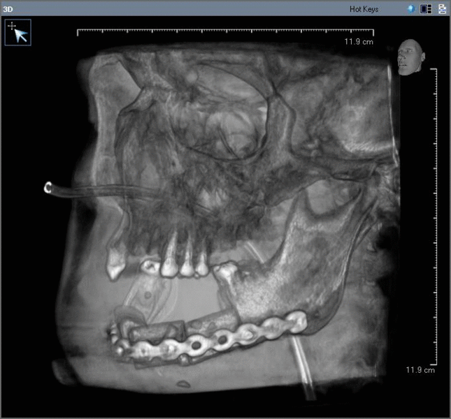 Post-operative image after removal of oral cancer with part of the mandible (fee.gif