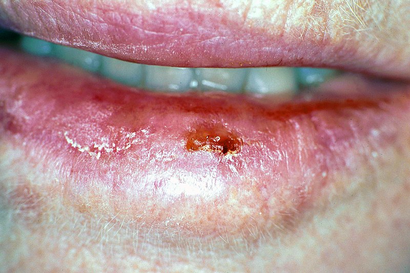 Ulceration on the left lower lip caused by cancer.jpg