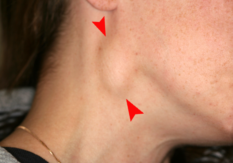 Swelling of the right neck from the spread of oral cancer..png