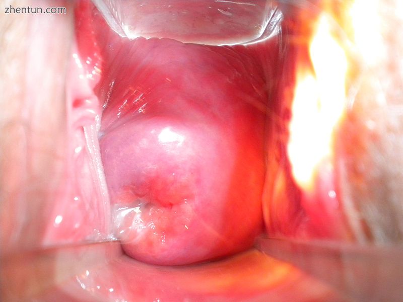 A normal cervix of an adult viewed using.jpg