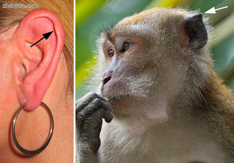 Ear showing Darwin&#039;s tubercle An evolutionary human-ear vestige in a woman;.jpg