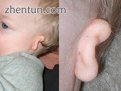 Microtia Grade III microtia affecting the left ear of a boy..jpg
