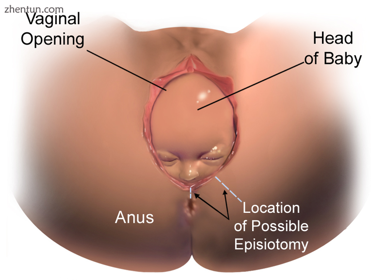Illustration of infant crowning and midline and medio-lateral incision sites for.png