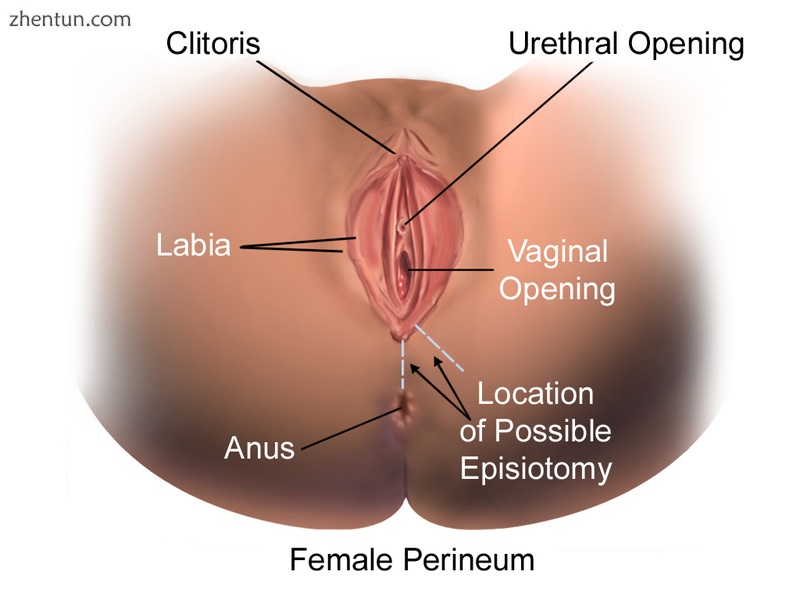Illustration of midline and medio-lateral incision sites for possible episiotomy..png