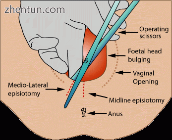Medio-lateral episiotomy as baby crowns..gif