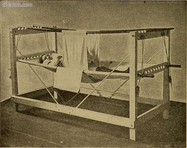Patient in a symphysiotomy hammock after surgery, 1907.jpg