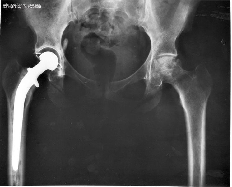 Hip joint replacement..jpg