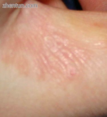 Scabies of the finger.jpg