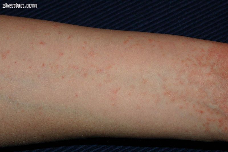 Scabies of the arm.jpg
