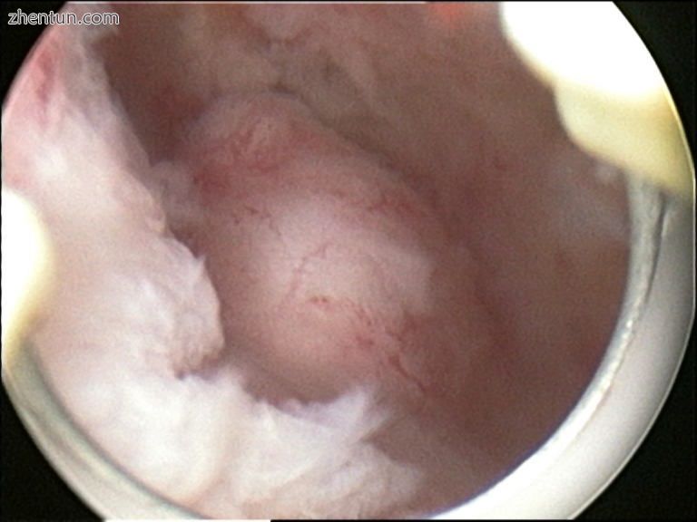 View of a submucous fibroid by hysteroscopy.jpg