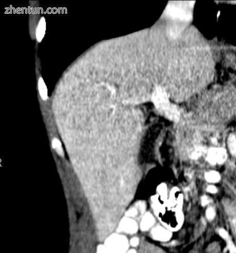 A CT scan in which the liver and portal vein are shown..jpg