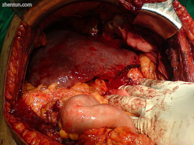 After resection of left lobe liver tumor.jpg