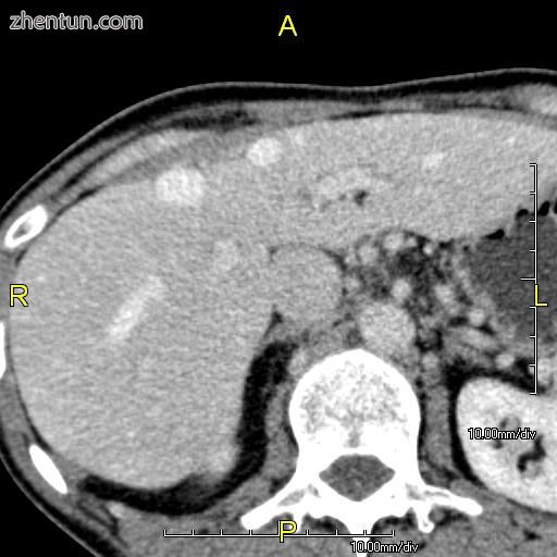 Axial CT image showing anomalous hepatic veins coursing on the subcapsular anter.jpg