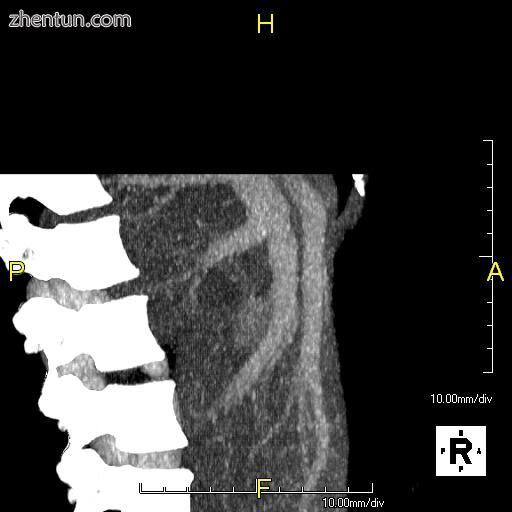 Lateral MIP view in the same patient.jpg