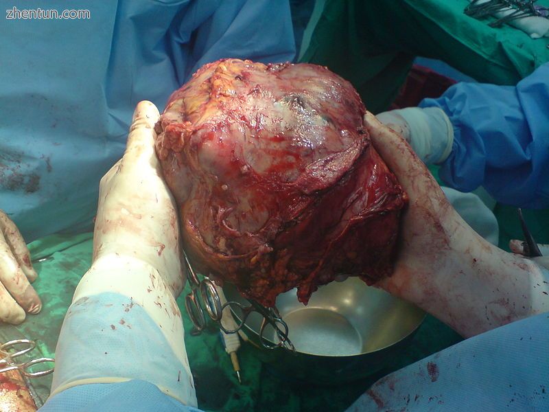Left lobe liver tumor.jpg