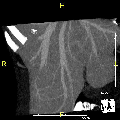 Maximum intensity projection (MIP) CT image as viewed anteriorly showing the ano.jpg