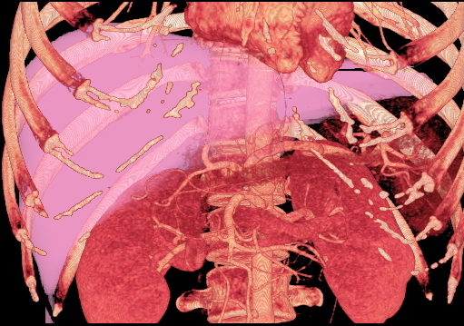MDCT image. 3D image created by MDCT can clearly visualize the liver, measure th.jpg