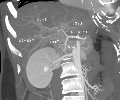 MDCT image. Arterial anatomy contraindicated for liver donation.jpg