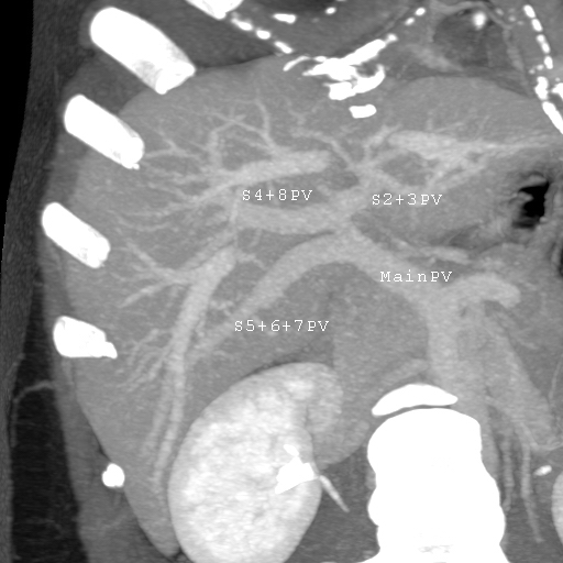 MDCT image. Portal venous anatomy contraindicated for liver donation.jpg