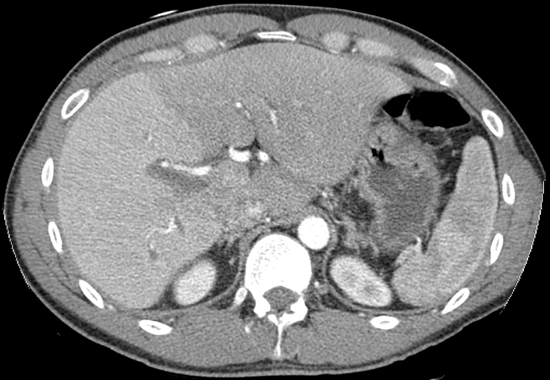 Phase contrast CT image. Contrast is perfusing the right liver but not the left .png