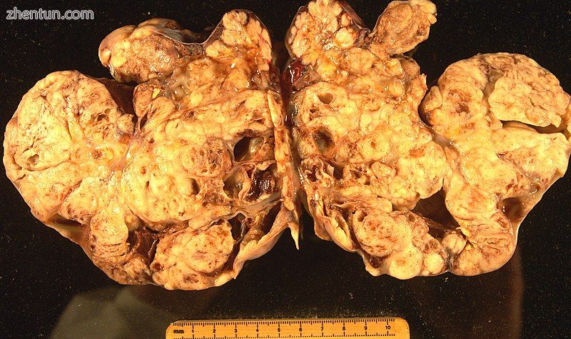 A pathological specimen of ovarian carcinoma.jpg