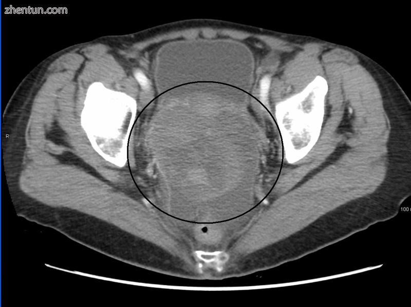 A very large ovarian cancer as seen on CT.png