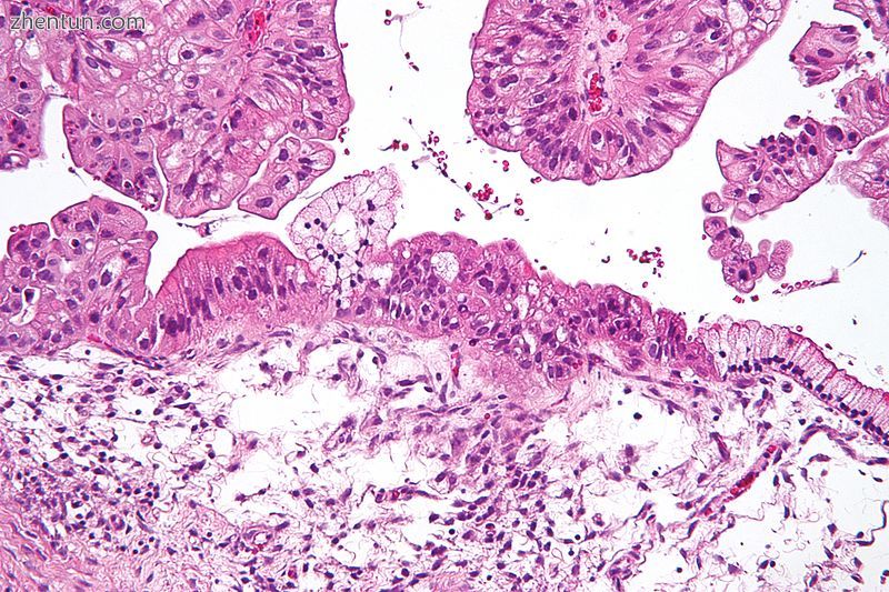 Micrograph of a mucinous ovarian carcinoma stained by H&amp;E..jpg