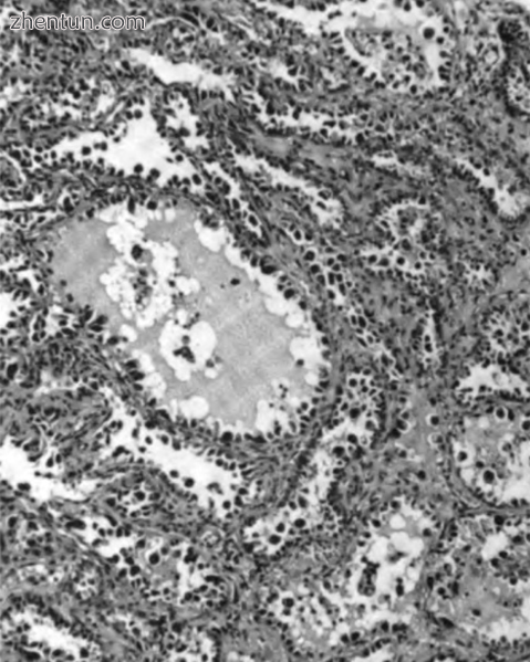 Hobnail cells seen in a clear cell carcinoma sample.png